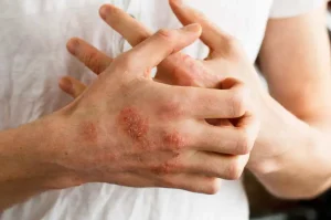10 Fakta Tentang Dermatitis Kontak Alergi