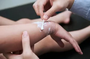 Pertolongan Pertama untuk Luka Bakar