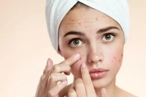 Tips Alami Menghilangkan Bekas Jerawat yang Wajib Anda Coba