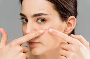 Tips Mengatasi Kulit Wajah yang Berjerawat