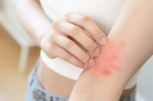 7 Tips Mengatasi Alergi Musiman dengan Cara Alami